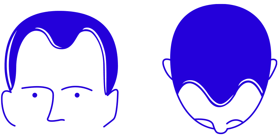 hair loss image
