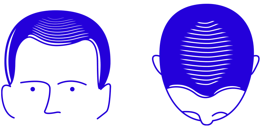 hair loss image